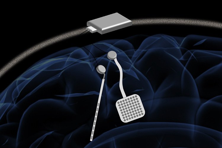 Device that works like pacemaker for brain, can treat epilepsy, Parkinson's