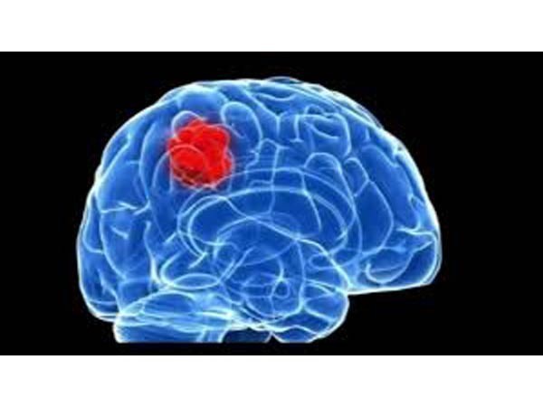 Brain protein linked to seizures, abnormal social behaviours, finds study