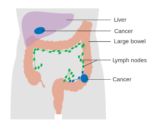 Bowel Screening Programme saves lives by detecting over 320 bowel cancers