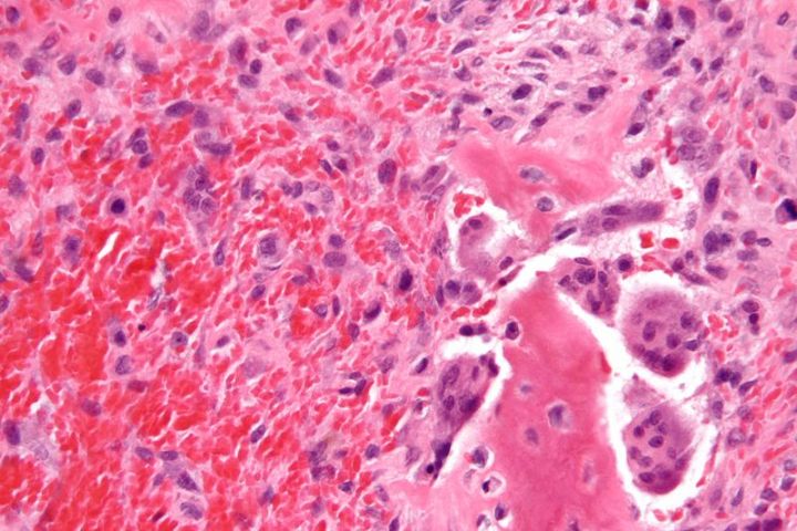 Researchers develop novel stem cell technique capable of killing tumours