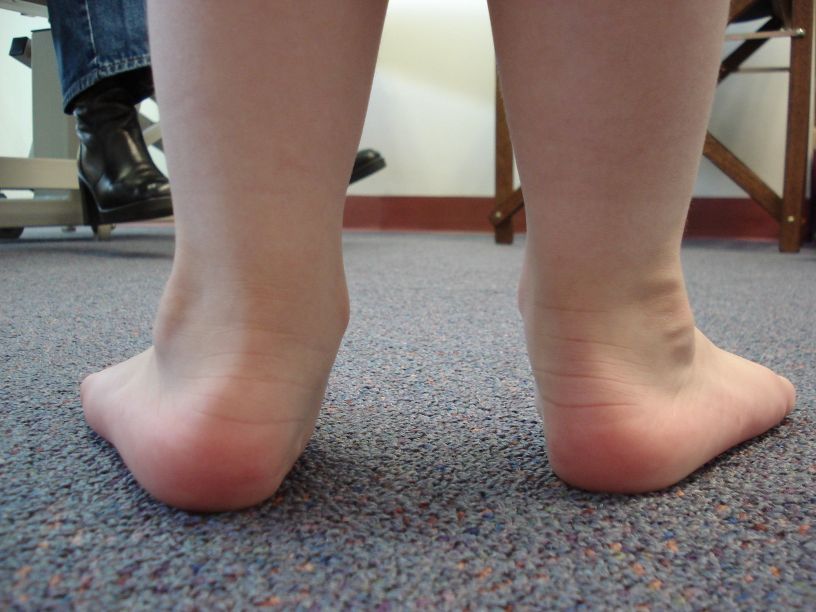 No, children don’t magically ‘grow out’ of flat feet. Treatment is key to avoid long-term pain