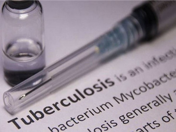 Tuberculosis treatment duration to be reduced soon as ICMR-NIRT initiate research