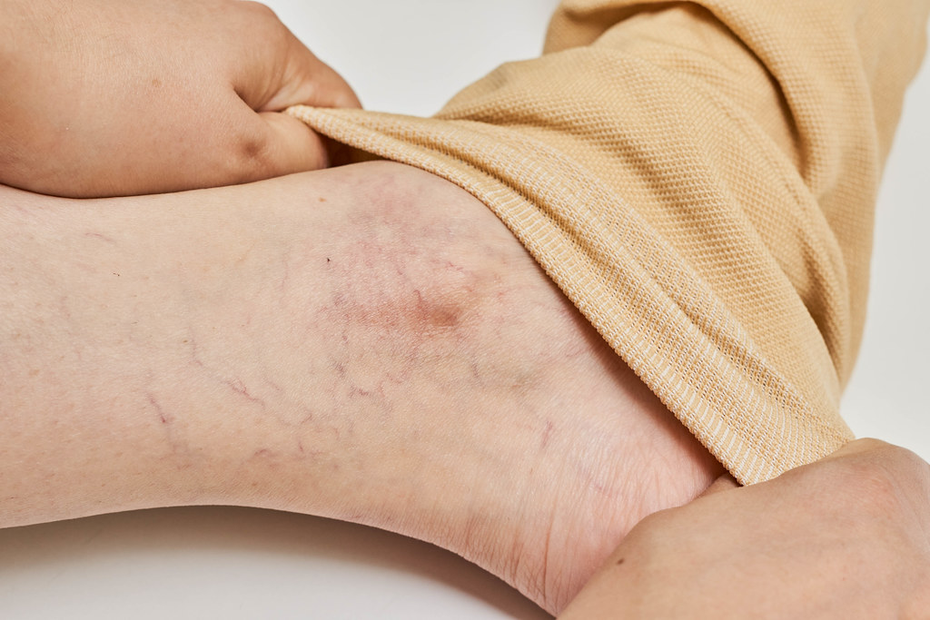 Unveiling the Truth about Varicose Veins: Expert Insights from Sri Ramakrishna Hospital's Vascular Specialists