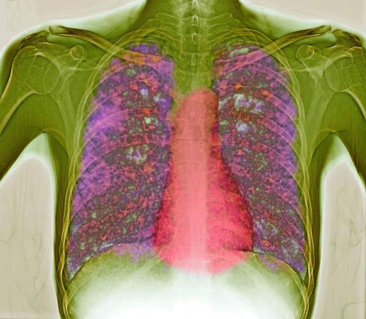 Researchers identify mechanism, which on deactivation can kill tuberculosis pathogen