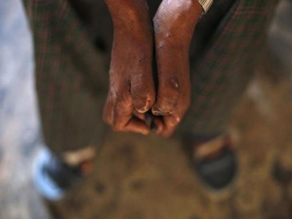 Cured but ostracised: Leprosy survivors ordeal far from over, continue to battle stigma