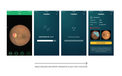 Path-breaking Study Reports High Sensitivity in Diabetic Retinopathy Screening Using Smartphones and Automated-AI in Primary-Care: Remidio Innovative Solutions