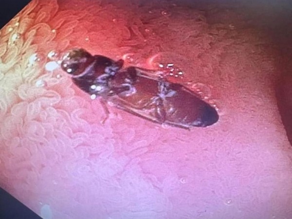 Miraculous Medical Intervention: Cockroach Extracted from Patient's Stomach