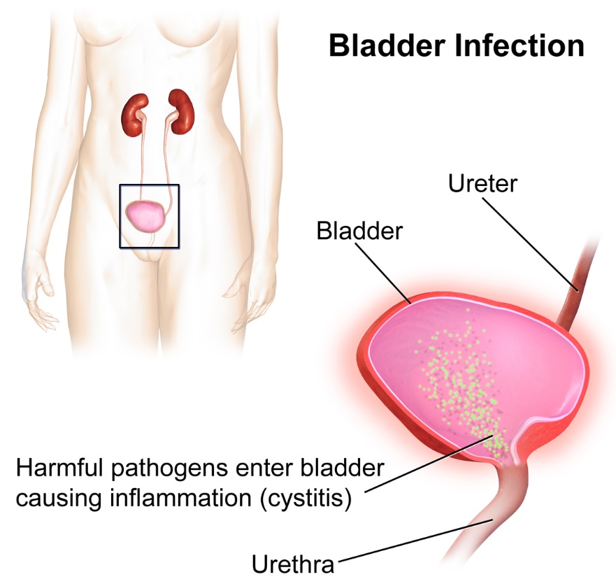 Why urinary tract infections have high recurrence rate in postmenopausal women