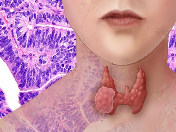 Thyroid inflammation linked to anxiety disorders, finds study