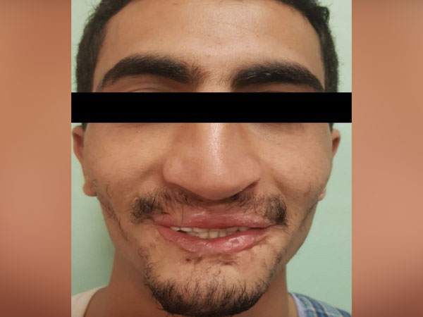 Mobile blast in mouth injure Yemen youth, gets fresh lease of life with facial reconstruction surgery in India