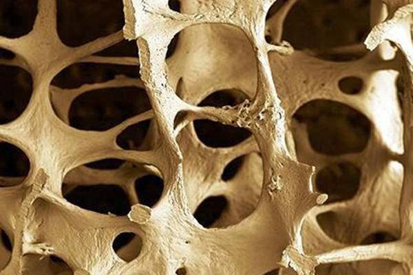 New study explores ways of treating bone loss condition osteoporosis