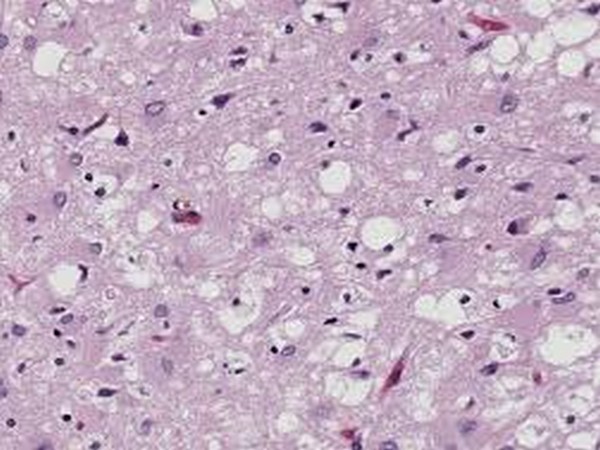 Researchers find new potential treatment for prion diseases