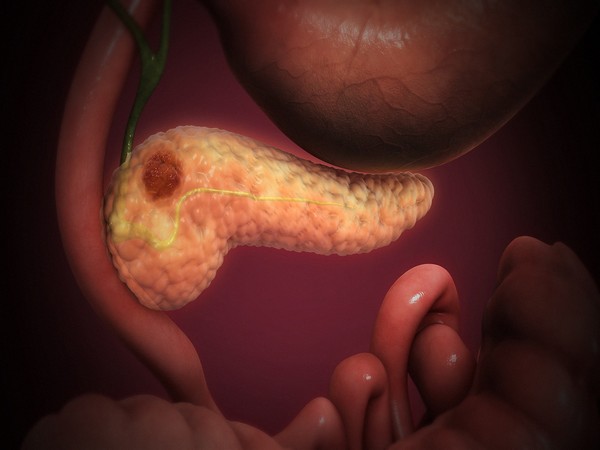 Foot and mouth disease virus to help treat pancreatic cancer