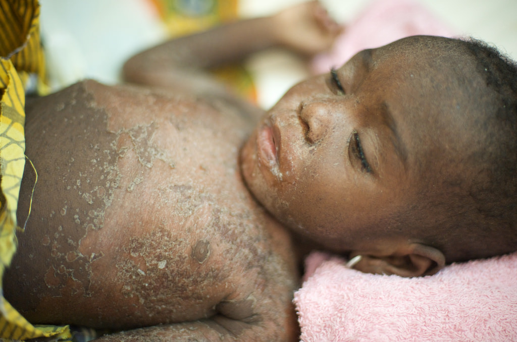 Zimbabwe measles outbreak blamed on sect gatherings kills 157 children