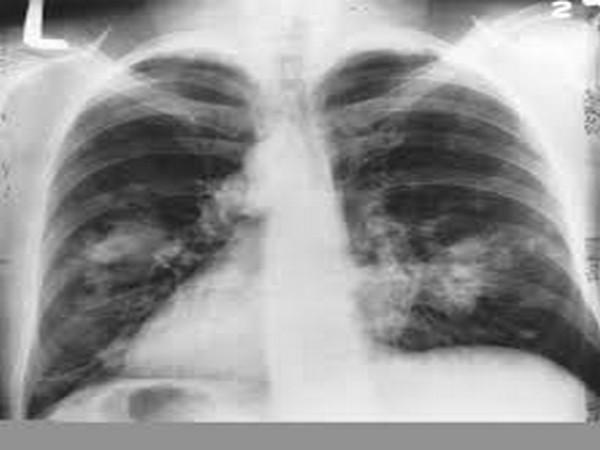 New combination of immunotherapies shows great promise for treating lung cancer