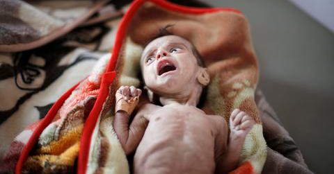 Do shameless war mongers hear? Trying to make Yemen child smile 'like tickling a ghost', says U.N. food chief