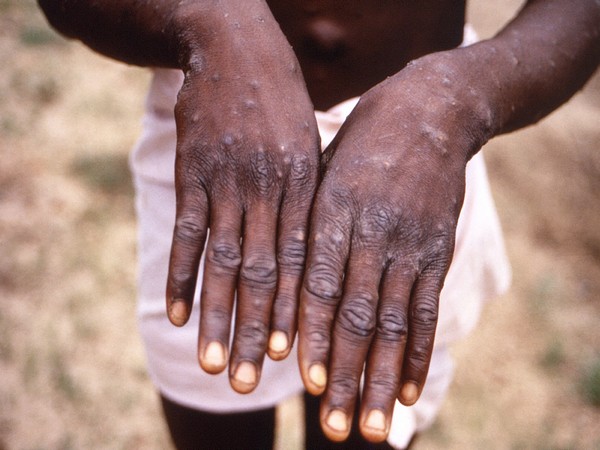WHO to use new synonym 'mpox' for monkeypox disease