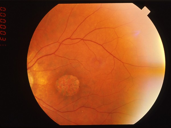 Study finds treatment for blindness causing syndrome | Health