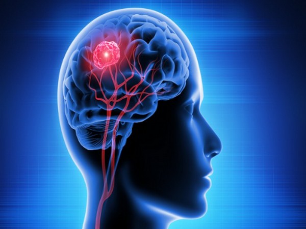 Genetic malfunction of brain astrocytes triggers migraine: Study