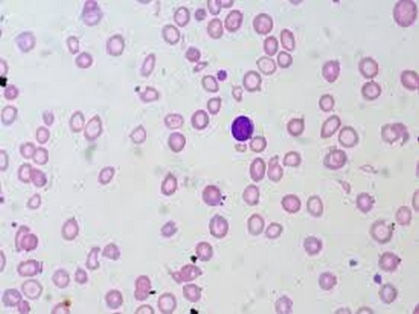Study reveals improved treatment for children with sickle cell anemia