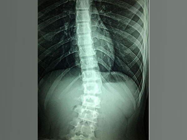 Over 5 million Chinese students, adolescents suffer from spinal deformities
