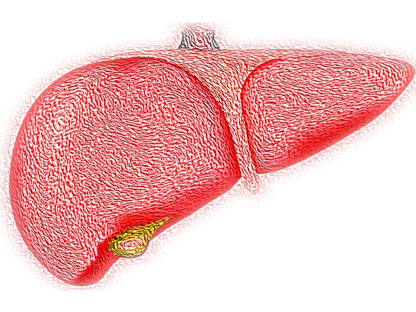 First-degree relatives of patients with NAFLD at risk of liver disease: Research