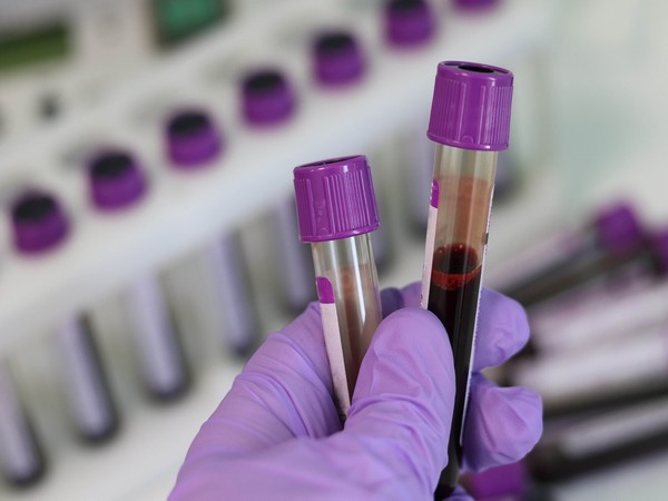 ALS may now be diagnosed with simple, reliable blood tests: Study