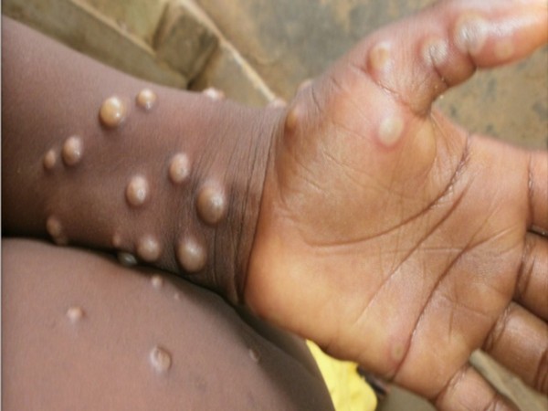 8-year-old boy reports monkeypox symptoms in Andhra's Guntur