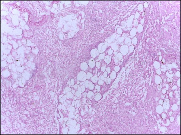 Researchers find a new method to identify aggressive breast cancer