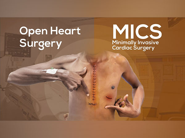 Transforming Heart Care: The Rise of Minimally Invasive Cardiac Surgery