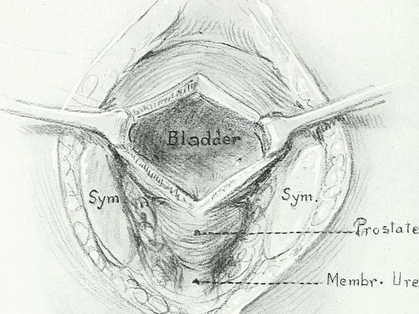 Individualised physical therapy after prostate surgery can reduce incontinence, pain