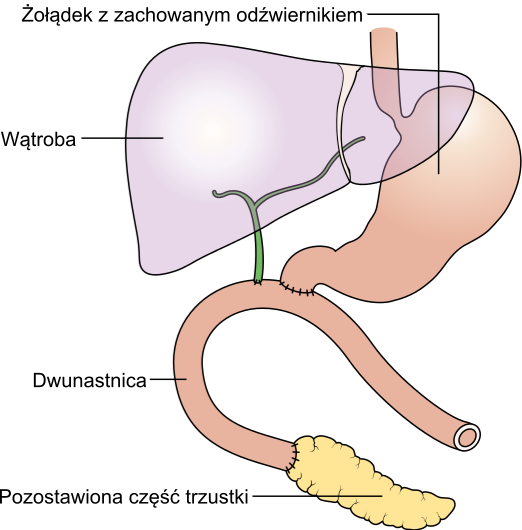 How technology has made pancreatic surgery many times more safe?  